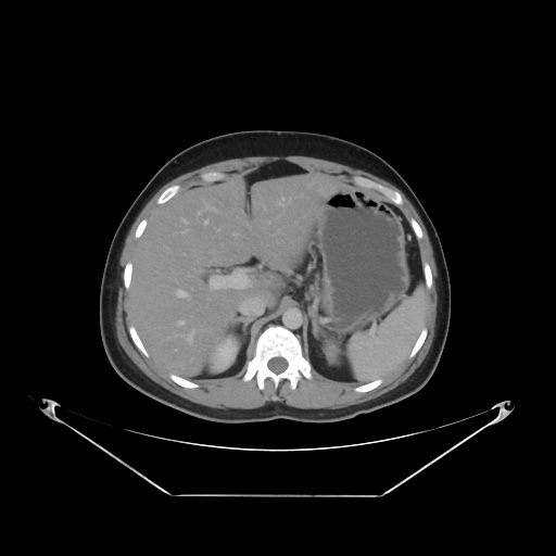 File:Acute complicated calculous cholecystitis (Radiopaedia 55202-61587 Axial C+ delayed 30).jpg