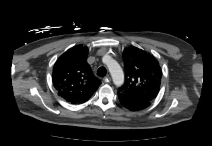 File:Acute cor pulmonale (ultrasound) (Radiopaedia 83508-98818 Axial 144).jpg