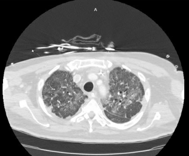 File:Acute cor pulmonale (ultrasound) (Radiopaedia 83508-98818 Axial lung window 21).jpg