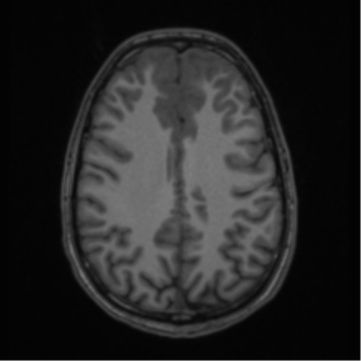 Acute disseminated encephalomyelitis (ADEM) (Radiopaedia 65319-74349 Axial T1 46).png