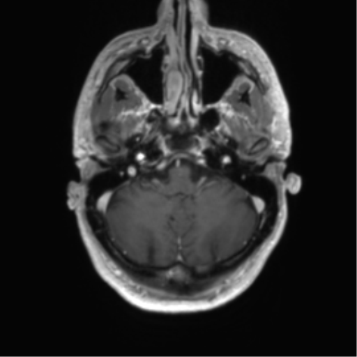 Acute disseminated encephalomyelitis (ADEM) (Radiopaedia 65319-74350 Axial T1 C+ 7).png