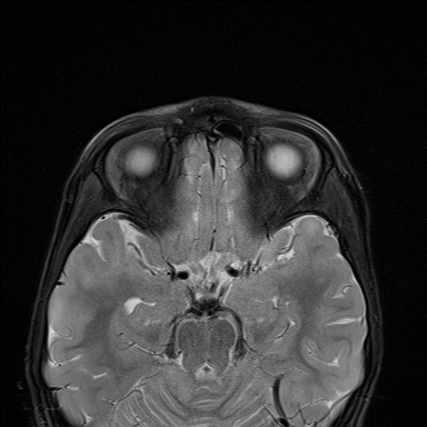 File:Acute disseminating encephalomyelitis with bilateral optic neuritis (Radiopaedia 79676-92886 Axial STIR 10).jpg