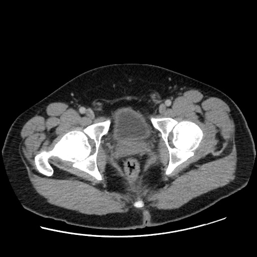 Acute diverticulitis with localized perforation (Radiopaedia 41296-44113 Axial C+ portal venous phase 88).jpg