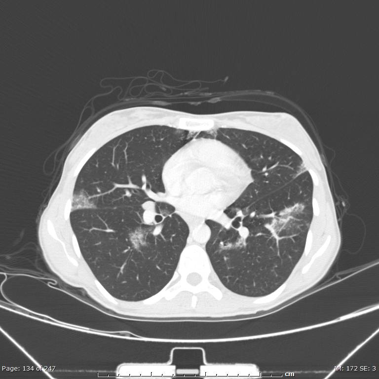Acute eosinophilic pneumonia (Radiopaedia 48211-53073 Axial lung window 48).jpg