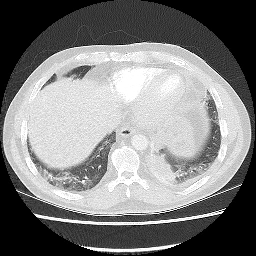 Acute epicardial fat necrosis (Radiopaedia 42327-45440 Axial lung window 44).jpg