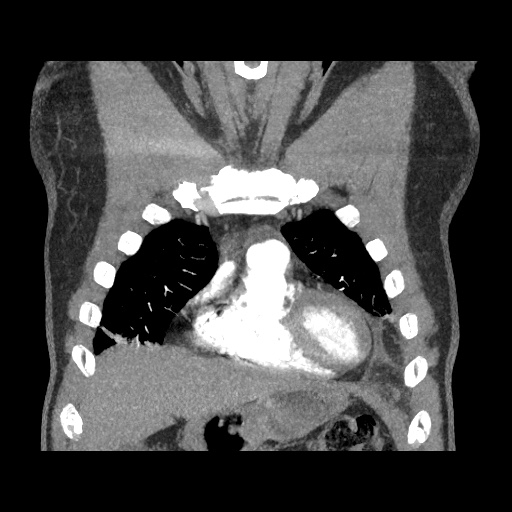Acute epicardial fat necrosis (Radiopaedia 42327-45440 Coronal C+ CTPA 26).jpg