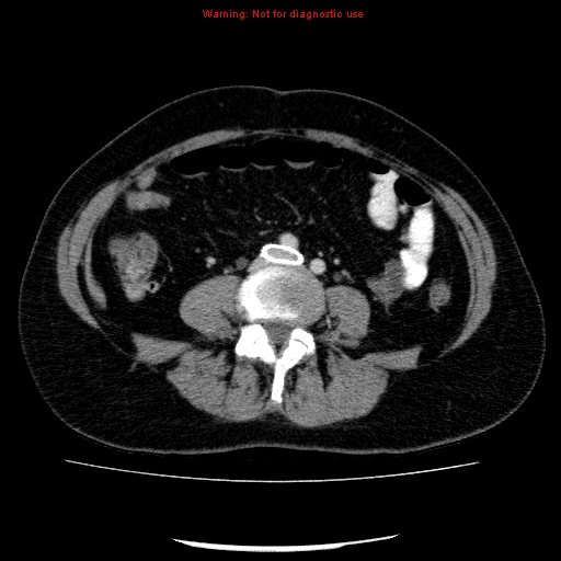 Acute gangrenous cholecystitis (Radiopaedia 10123-10661 Axial C+ portal venous phase 65).jpg