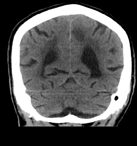 File:Acute left anterior cerebral artery territory infarction (Radiopaedia 51785-57578 Coronal non-contrast 45).jpg