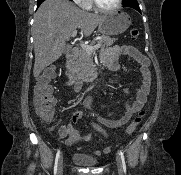 Acute mesenteric ischemia (Radiopaedia 80029-93316 Coronal C+ arterial phase 59).jpg