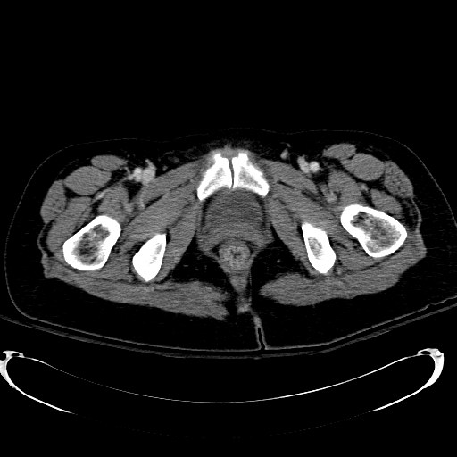Acute myocardial infarction in CT (Radiopaedia 39947-42415 Axial C+ portal venous phase 138).jpg