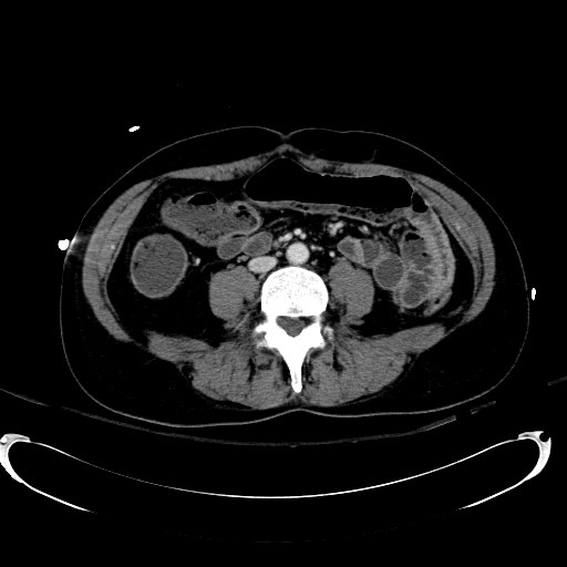 Acute myocardial infarction in CT (Radiopaedia 39947-42415 Axial C+ portal venous phase 76).jpg