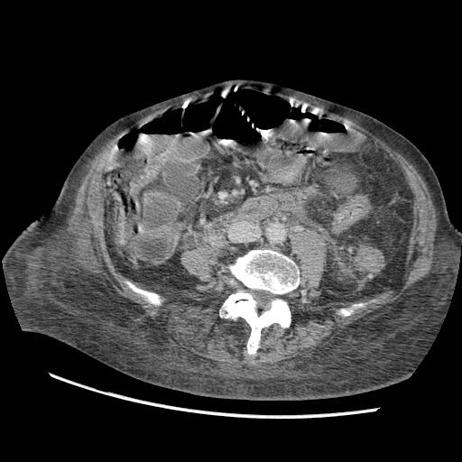 File:Acute on chronic pancreatitis (Radiopaedia 13233-13244 Axial C+ portal venous phase 70).jpg