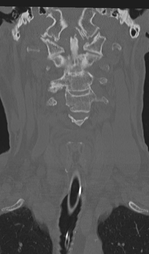 Acute on chronic subdural hematoma and thoracic vertebral injury in a multitrauma patient (Radiopaedia 31698-32619 Coronal bone window 17).jpg