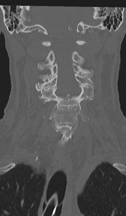 Acute on chronic subdural hematoma and thoracic vertebral injury in a multitrauma patient (Radiopaedia 31698-32619 Coronal bone window 27).jpg