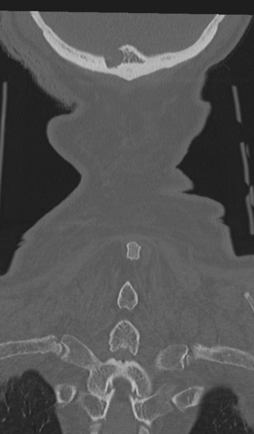 Acute on chronic subdural hematoma and thoracic vertebral injury in a multitrauma patient (Radiopaedia 31698-32619 Coronal bone window 64).jpg