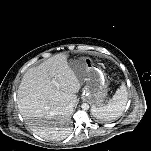 File:Acute pancreatic necrosis (Radiopaedia 13560-18501 Axial C+ portal venous phase 23).jpg