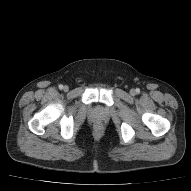 Acute pancreatitis (Radiopaedia 26663-26813 Axial C+ portal venous phase 88).jpg