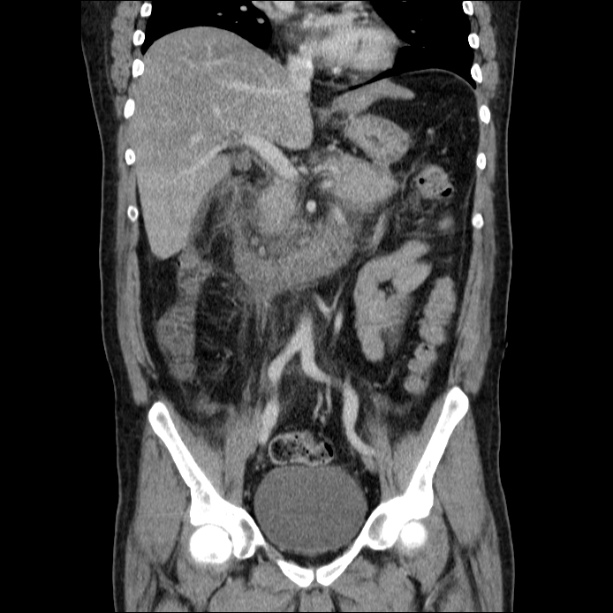 Acute pancreatitis (Radiopaedia 26663-26813 Coronal C+ portal venous phase 33).jpg