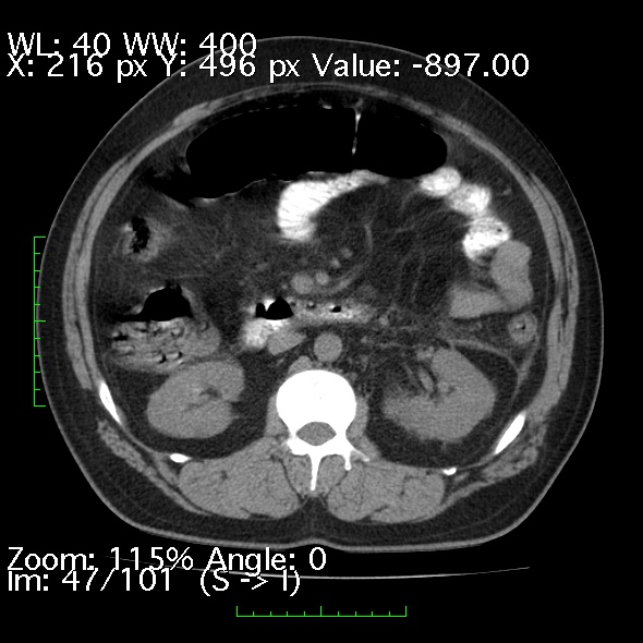 Acute pancreatitis (Radiopaedia 34043-35276 Axial non-contrast 47).jpg