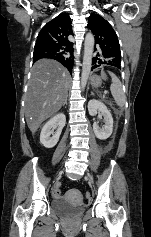 Acute pancreatitis (Radiopaedia 80007-93285 Coronal C+ portal venous phase 95).jpg