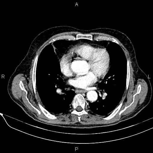 File:Acute pancreatitis (Radiopaedia 85146-100701 Axial C+ arterial phase 12).jpg