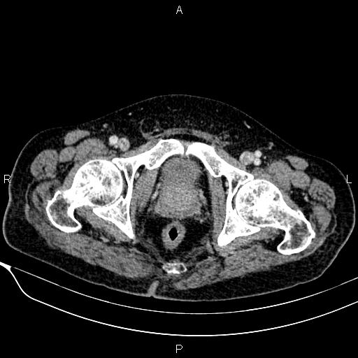Acute pancreatitis (Radiopaedia 85146-100701 Axial C+ portal venous phase 62).jpg