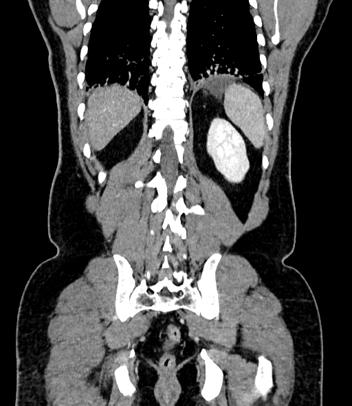 File:Acute pancreatitis (Radiopaedia 87428-103757 Coronal C+ portal venous phase 73).jpg