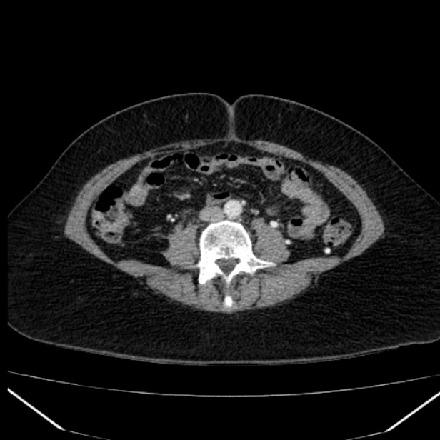 Acute pancreatitis - Balthazar C (Radiopaedia 26569-26714 Axial C+ arterial phase 56).jpg