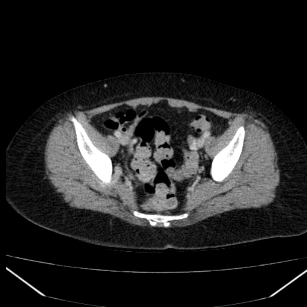 Acute pancreatitis - Balthazar C (Radiopaedia 26569-26714 Axial C+ portal venous phase 82).jpg