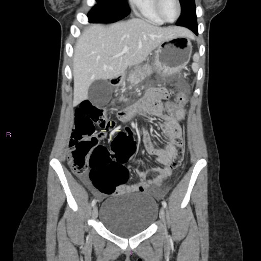 File:Acute pancreatitis secondary to stone at minor papilla and pancreatic divisum (Radiopaedia 76570-88333 Coronal C+ portal venous phase 3).jpg
