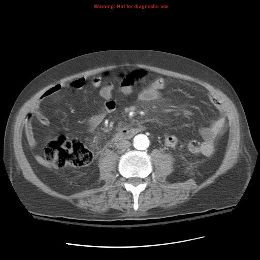 Acute pancreatitis with incidental pancreatic lipoma (Radiopaedia 10190-10730 Axial C+ arterial phase 60).jpg