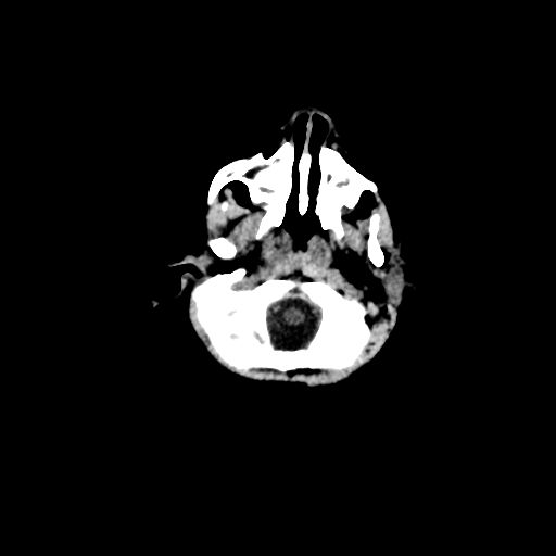 Acute phase of hemiconvulsion-hemiplegia epilepsy syndrome (Radiopaedia 29309-29744 Axial non-contrast 49).jpg