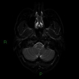 Acute posterior cerebral artery territory infarct (Radiopaedia 79329-92394 Axial DWI 33).jpg