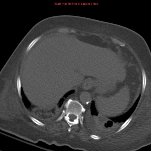 File:Acute pulmonary embolism (Radiopaedia 13286-13289 Axial C+ CTPA 59).jpg