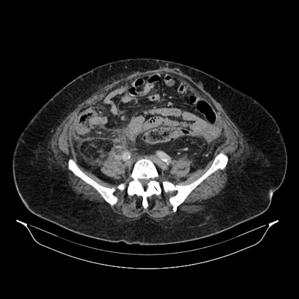 Acute pyelonephritis (Radiopaedia 25657-25837 Axial renal parenchymal phase 55).jpg