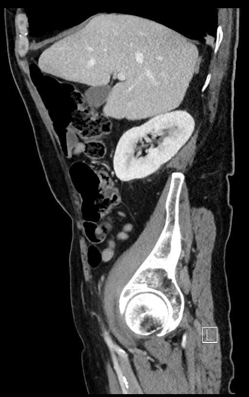 Acute renal infarction (Radiopaedia 59375-66736 Sagittal C+ portal venous phase 43).jpg