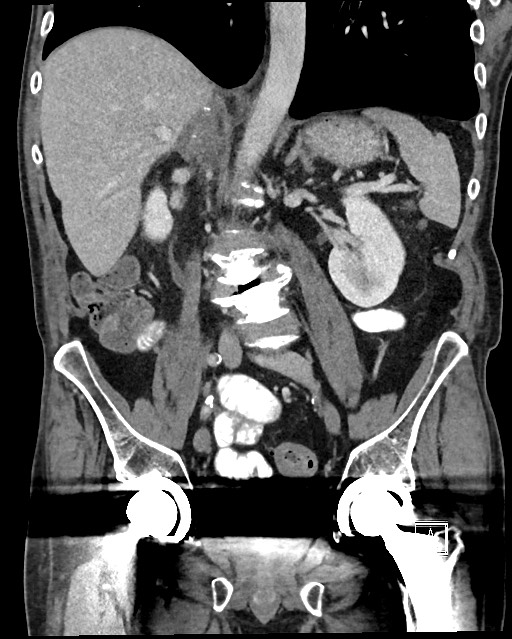 Acute renal infarction - rim capsular enhancement (Radiopaedia 59833-67270 Coronal C+ portal venous phase 32).jpg