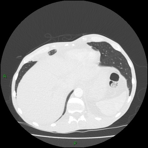 File:Acute right lung abscess (Radiopaedia 34806-36258 Axial lung window 163).jpg