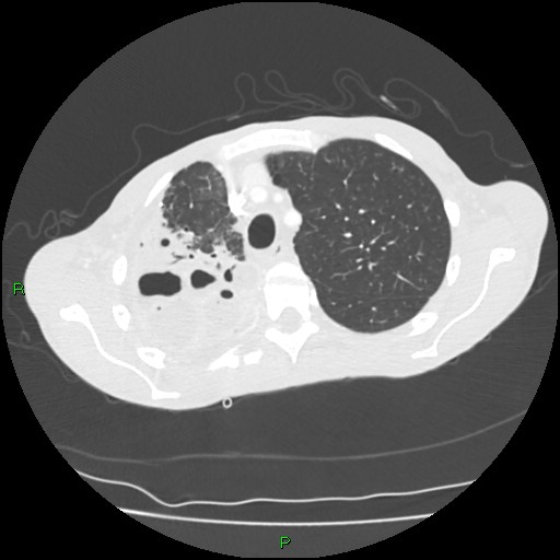 Acute right lung abscess (Radiopaedia 34806-36258 Axial lung window 43).jpg