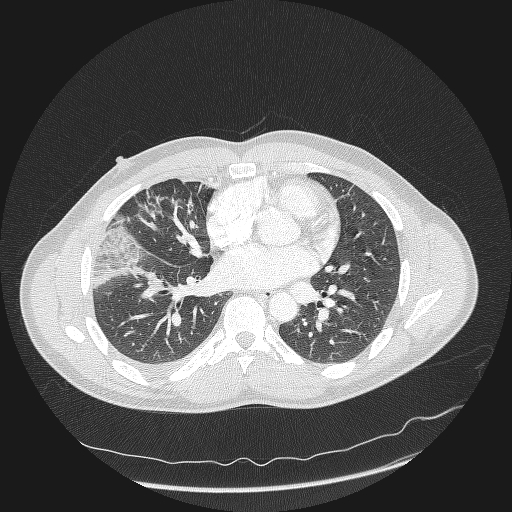 Acute segmental pulmonary emboli and pulmonary infarction (Radiopaedia 62264-70444 Axial lung window 108).jpg