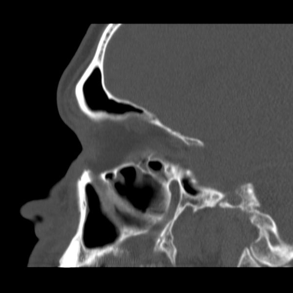 Acute sinusitis (Radiopaedia 23161-23215 Sagittal bone window 25).jpg