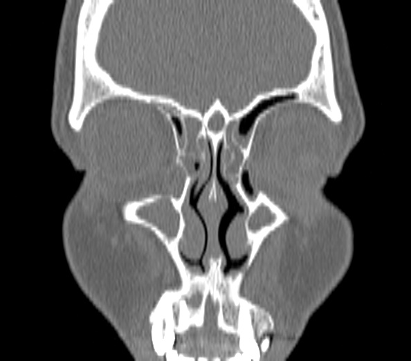 Acute sinusitis (Radiopaedia 40564-43158 Coronal bone window 7).jpg