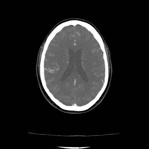 Acute subarachnoid hemorrhage and accessory anterior cerebral artery (Radiopaedia 69231-79009 Axial C+ arterial phase 104).jpg