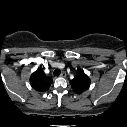 Acute subarachnoid hemorrhage and accessory anterior cerebral artery (Radiopaedia 69231-79009 Axial C+ arterial phase 22).jpg