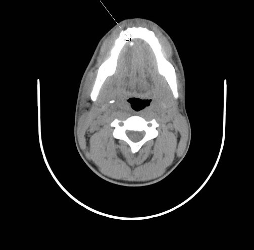 File:Acute submandibular sialadenitis secondary to ductal stone (Radiopaedia 27999-28267 Axial non-contrast 2).jpg