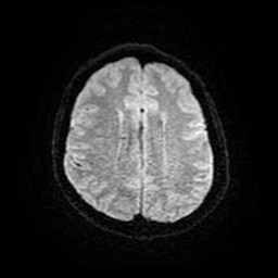 File:Acute superior cerebellar artery territory infarct (Radiopaedia 84104-99358 Axial DWI 12).jpg