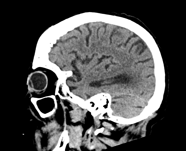 Acute traumatic subdural hematoma (Radiopaedia 82921-97257 Sagittal non-contrast 24).jpg