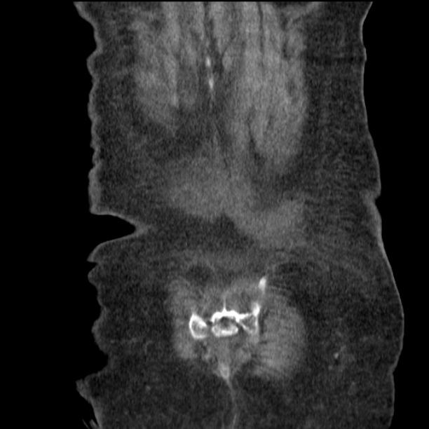 Acute tubular necrosis (Radiopaedia 28077-28334 G 76).jpg