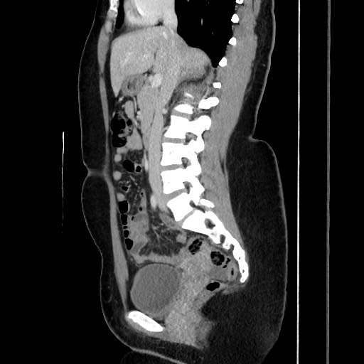 File:Acute uncomplicated appendicitis (Radiopaedia 73704-84499 Sagittal C+ portal venous phase 104).jpg