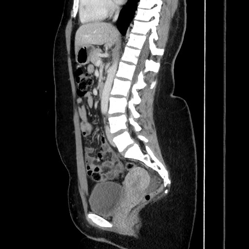 File:Acute uncomplicated appendicitis (Radiopaedia 73704-84499 Sagittal C+ portal venous phase 116).jpg